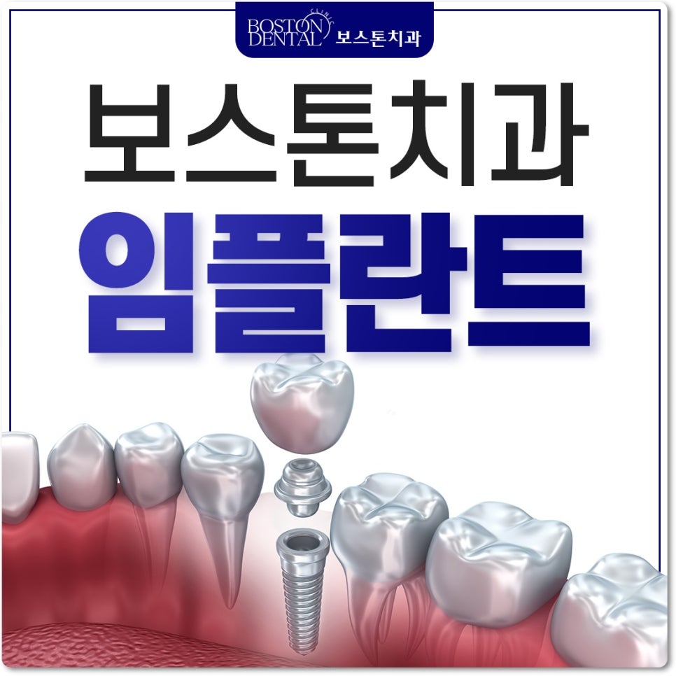 종로구치과 임플란트에 대해서 알고 싶으시다면? 관련 이미지 1