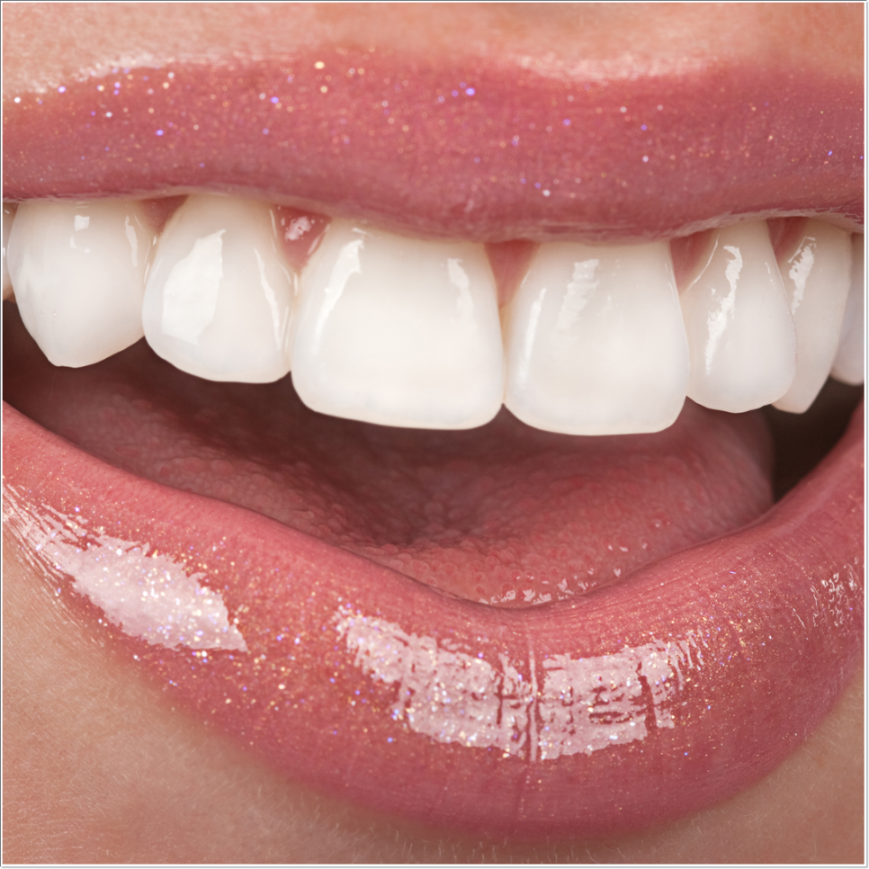 치아 변색 고민 끝, 을지로치과에서 듣는 라미네이트 사례 관련 이미지 13