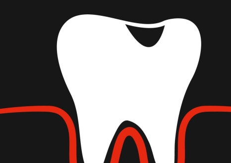 충치, 치료 미루면 더 아프고 더 비싸집니다 &ndash; 종각치과에서 꼭 알아야 할 이야기 관련 이미지 24