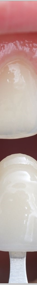 명동치과 치아 라미네이트의 모든 것: 앞니부터 어금니까지 관련 이미지 13