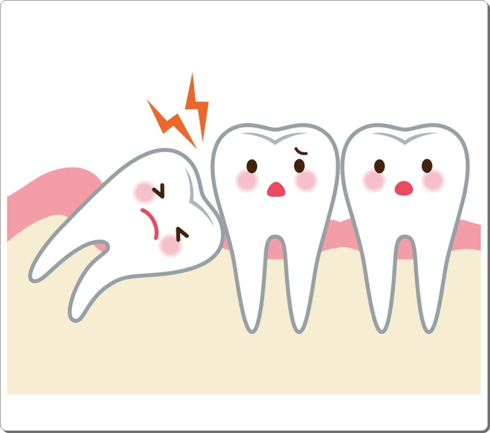 사랑니는 꼭 빼야 하는 치아일까요? 관련 이미지 1