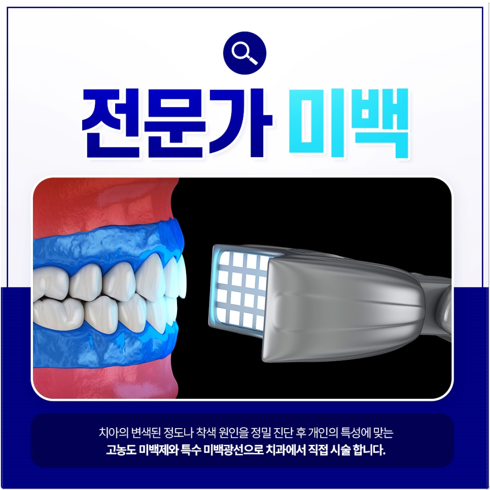 종각역치과 치아미백 효과를 오래 유지하고 싶어요 관련 이미지 3