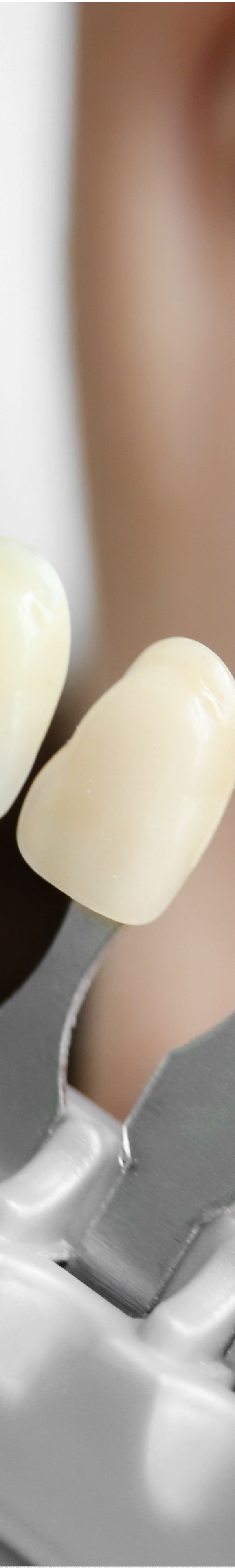 을지로입구역치과에서 알려드리는 치아미백과 라미네이트의 모든 것 관련 이미지 19