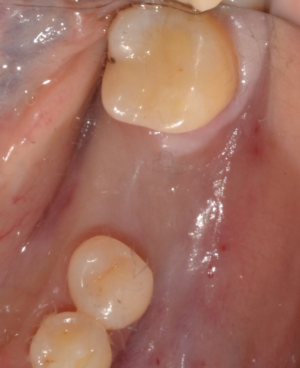 종로구치과 발치한지 2~3년이 지났어요 관련 이미지 4