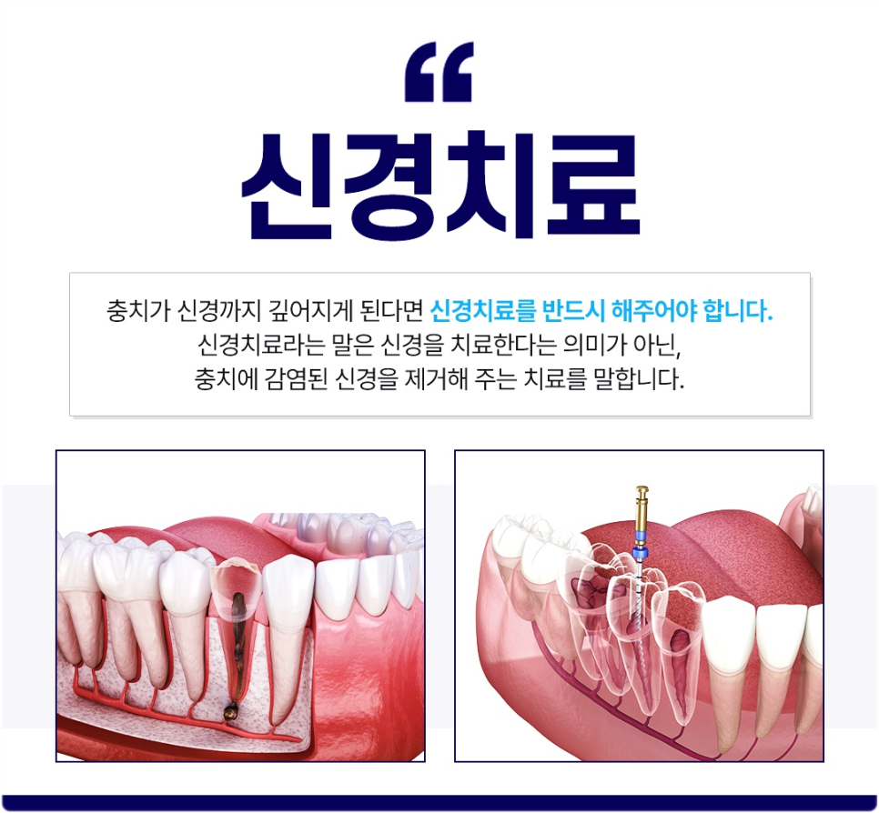 광화문역치과 신경치료 과정이 궁금해요 관련 이미지 4