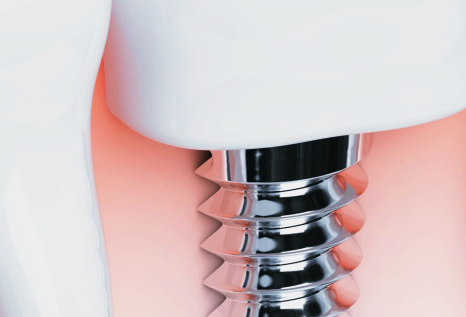 종로임플란트 건강한 치아를 위한 현명한 선택 관련 이미지 24