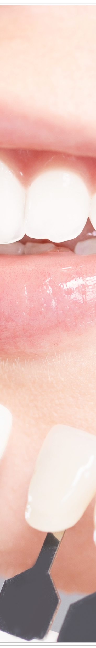 종로치과에서 알려드리는 치아미백과 라미네이트의 모든 것 관련 이미지 36