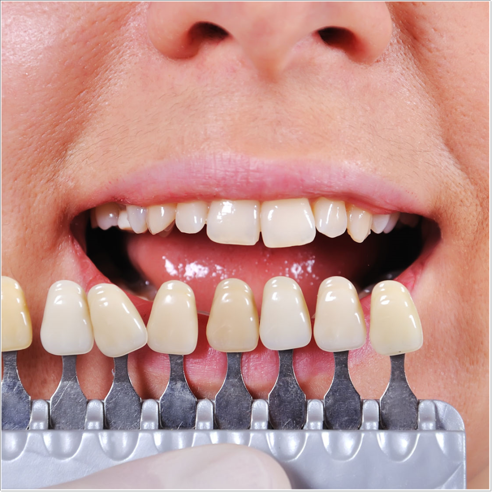 치아 변색 고민 끝, 을지로치과에서 듣는 라미네이트 사례 관련 이미지 22