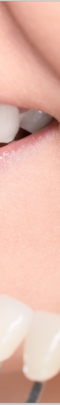 명동치과 치아 라미네이트의 모든 것: 앞니부터 어금니까지 관련 이미지 25