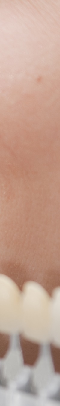 종로치과 자연스러운 라미네이트 색, 얼마나 하얘야 예쁠까? 관련 이미지 14