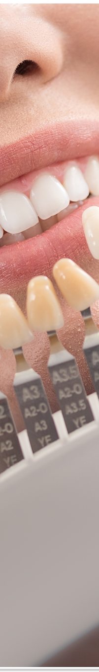 광화문역치과 치아미백과 라미네이트 나에게 필요한 건? 관련 이미지 18