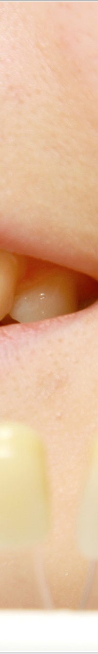 명동라미네이트, 단시간에 환한 미소를 가지고 싶다면? 관련 이미지 12