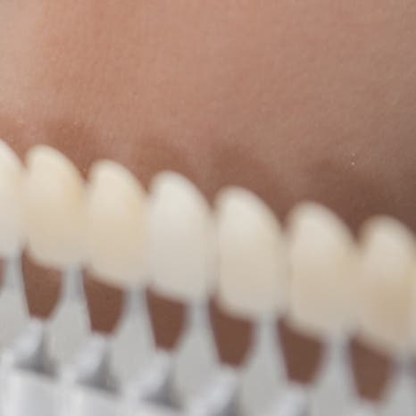 을지로입구치과 라미네이트 치료, 어디까지 알고 있나요? 관련 이미지 14