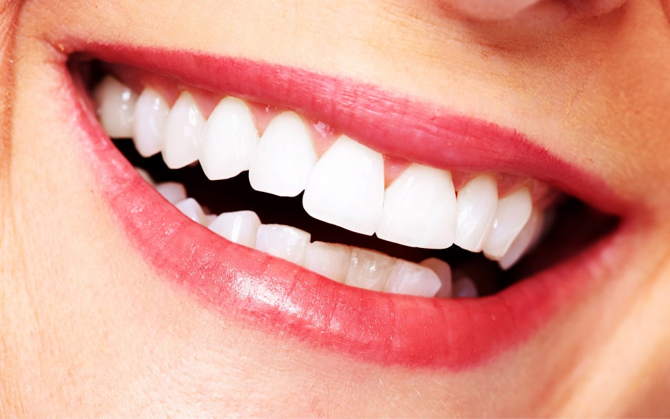 종각치과에서 알려드리는 치아미백과 라미네이트 이후의 달라진 일상 관련 이미지 10