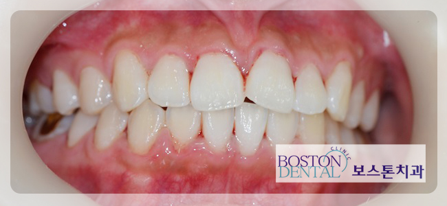 광화문치아교정 누구나 OK 관련 이미지 4