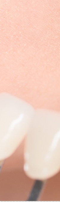 종로치과 라미네이트 주변 치아를 확인하여 자연스럽게 관련 이미지 25