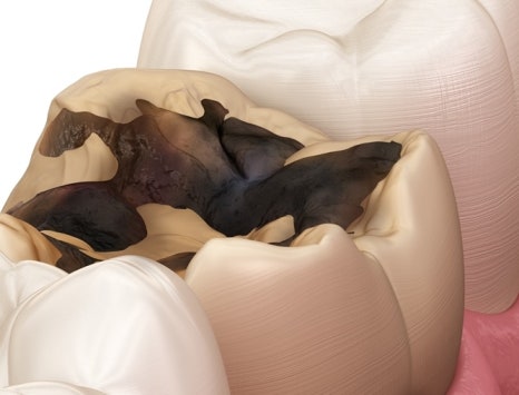 종각치과 너무 많은 치과 치료가 헷갈린다면? 관련 이미지 25