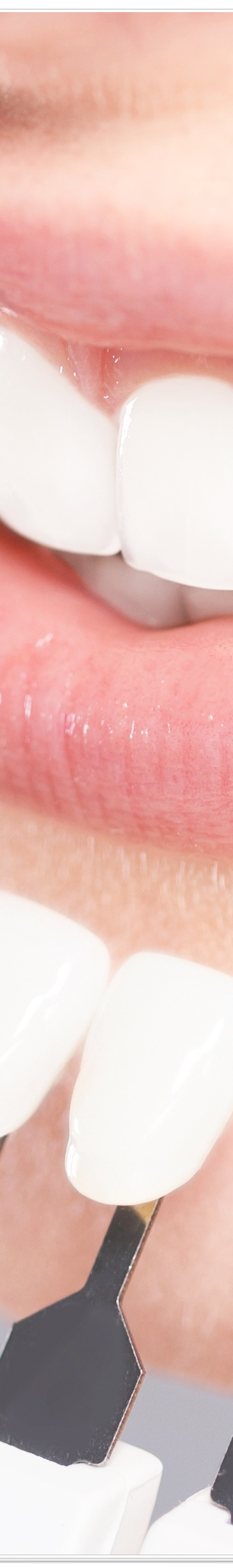 종로치과에서 알려드리는 치아미백과 라미네이트의 모든 것 관련 이미지 35