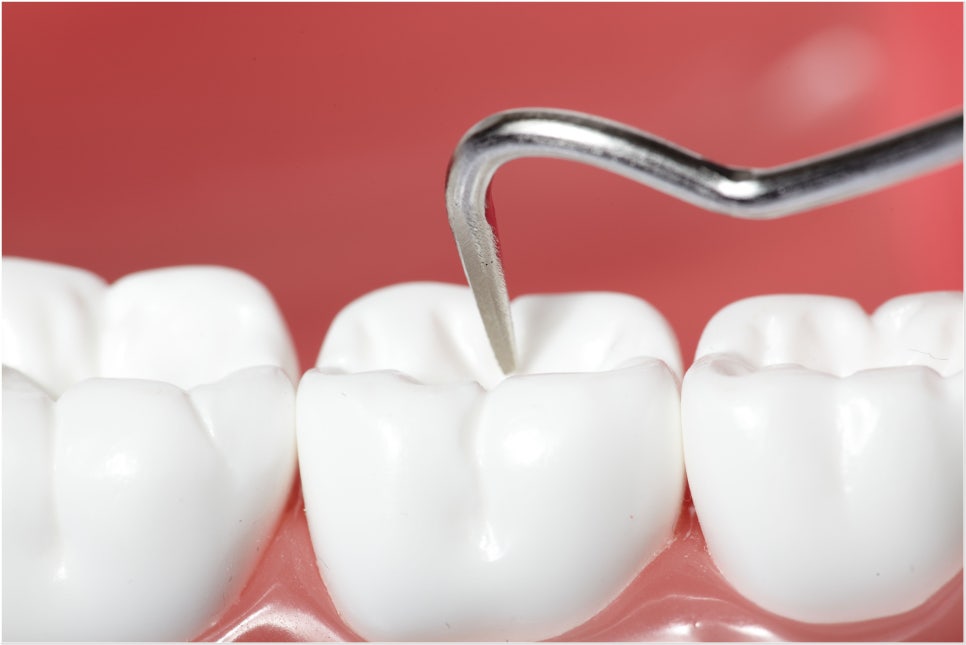 스케일링 아직 올 해 한번도 안 받으셨다면? 관련 이미지 1