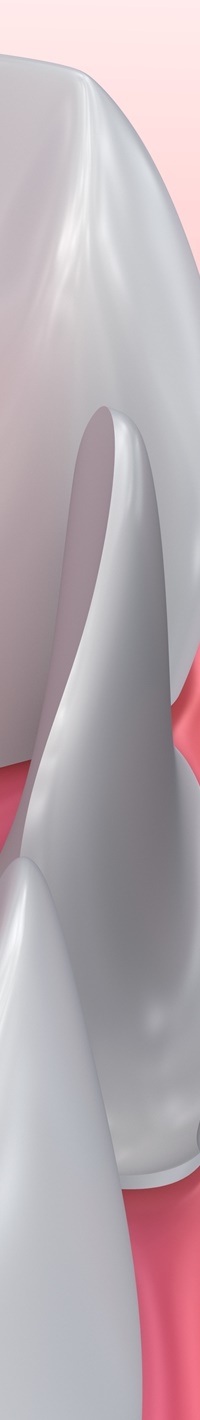 명동치과 주변 치아와 자연스러운 라미네이트 하는 방법 관련 이미지 26