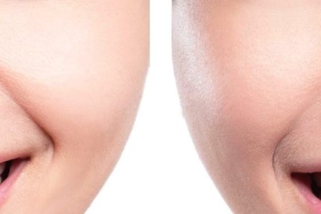 명동치과에서 알아보는 치아미백의 모든 것 관련 이미지 20