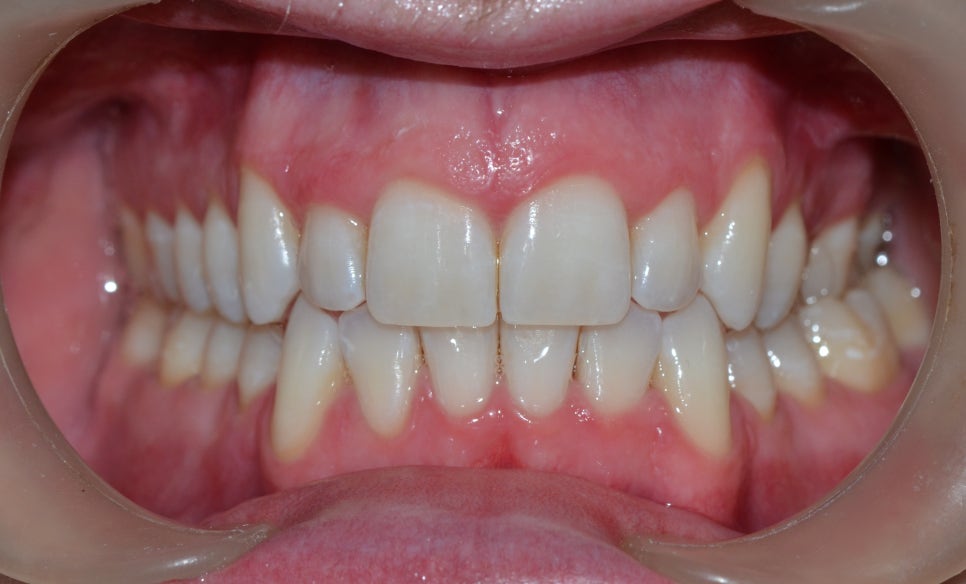 을지로입구역치과 치아 미백 전후 알아봐요! (Tooth whitening) 관련 이미지 7