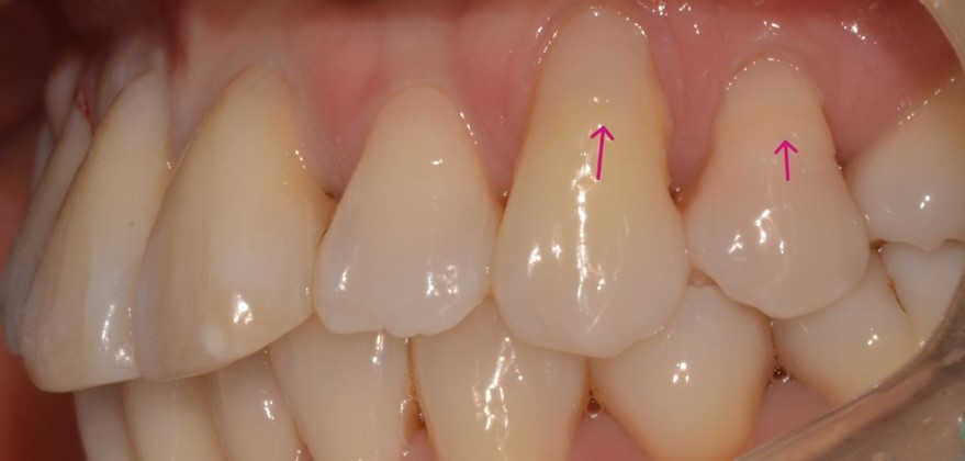 종로치과 치아 마모 때문에 이가 너무 시려요! 관련 이미지 3