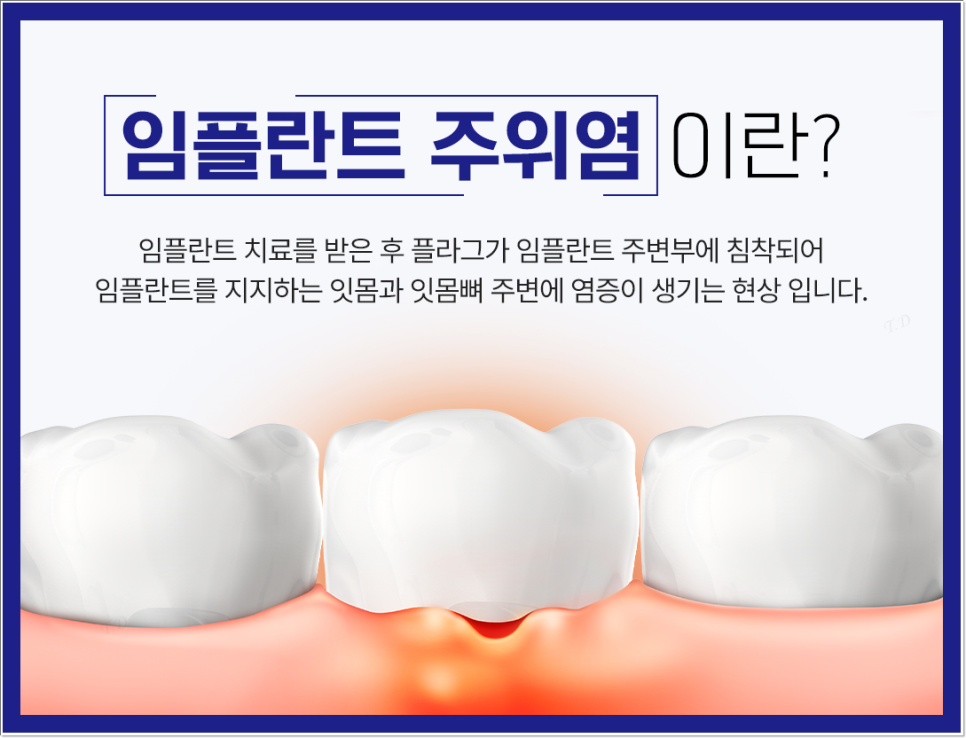 광화문역치과 50대도 늦지 않은 임플란트, 성공을 위한 주의 사항? 관련 이미지 6