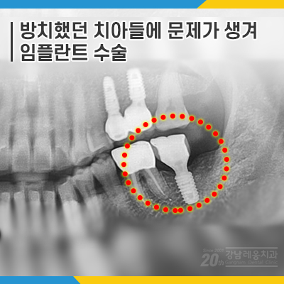 오래 방치했던 치아들 결국 임플란트 수술 관련 이미지 1