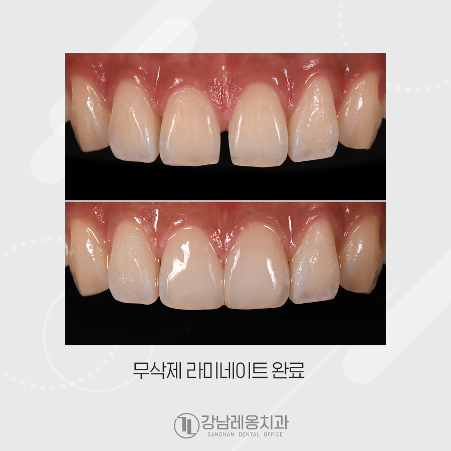 앞니 벌어짐 무삭제 라미네이트 치료는 장단점 꼭 확인! 관련 이미지 3