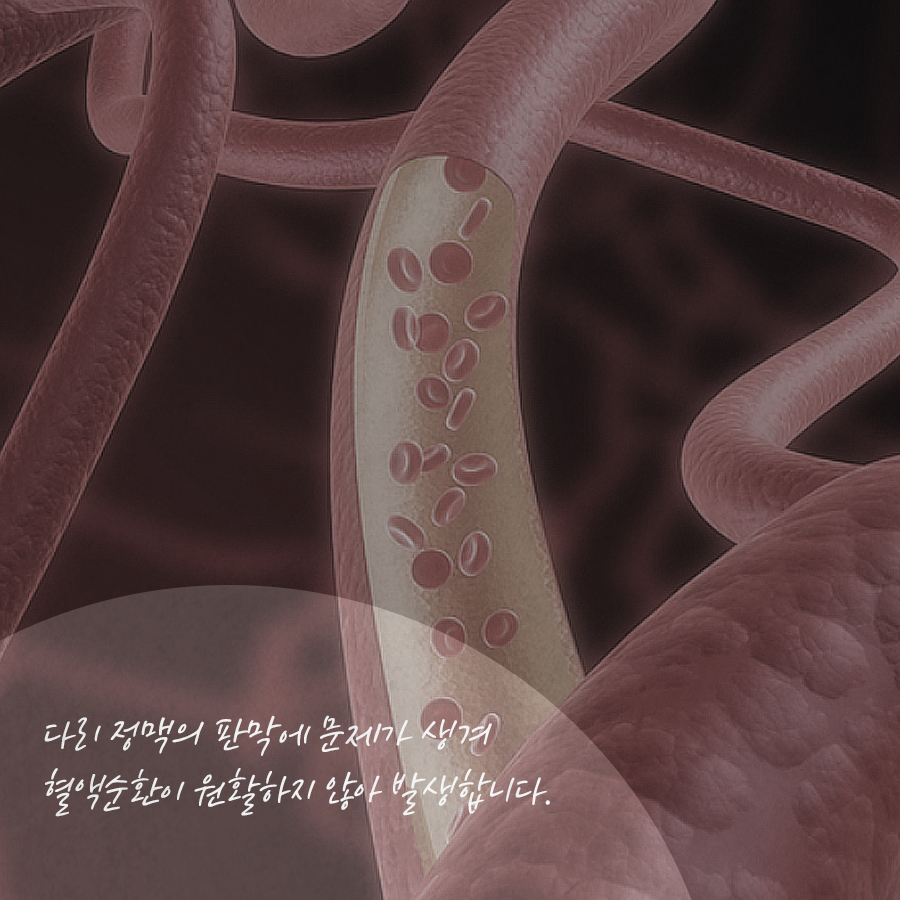 장시간 같은 자세? 하지정맥류 조심해요! 관련 이미지 2