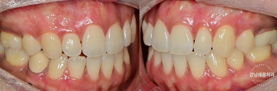 잇몸미백 효과 있나요? 시술 전후와 유지기간, 부작용까지!  / 강남레옹치과 뉴티스 잇몸미백 관련 이미지 7