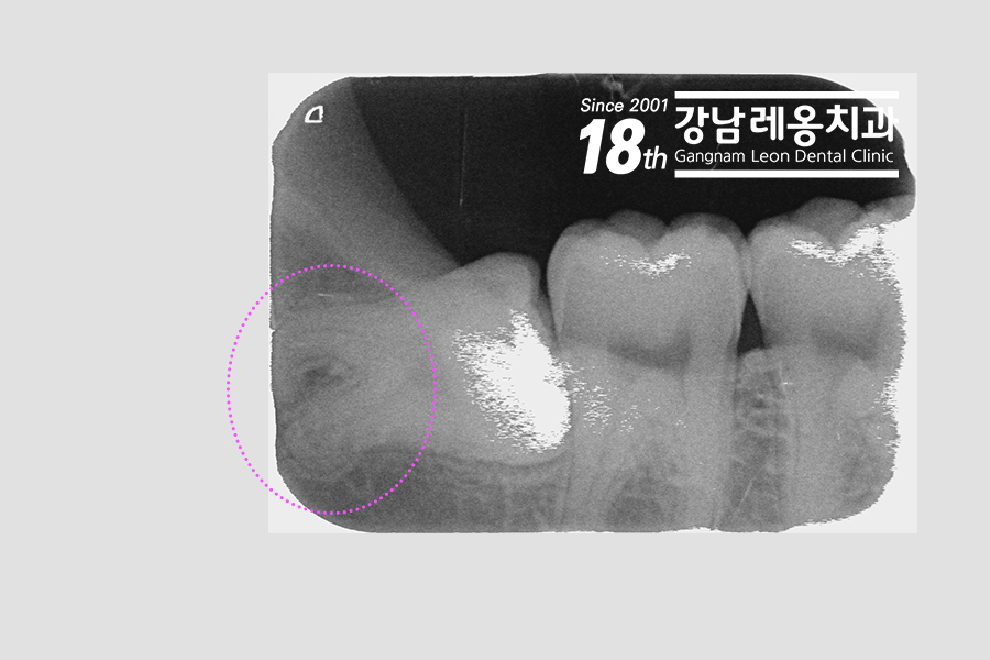 강남 레옹치과 뿌리 휘어진 사랑니 발치, 2개 한꺼번에 뽑은 사례 관련 이미지 2