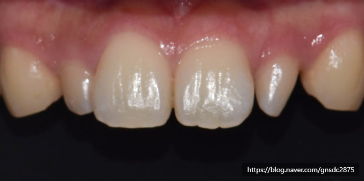 치아가 작아서 콤플렉스? 왜소치 개선 전후 사례👐 / 강남레옹치과 관련 이미지 6
