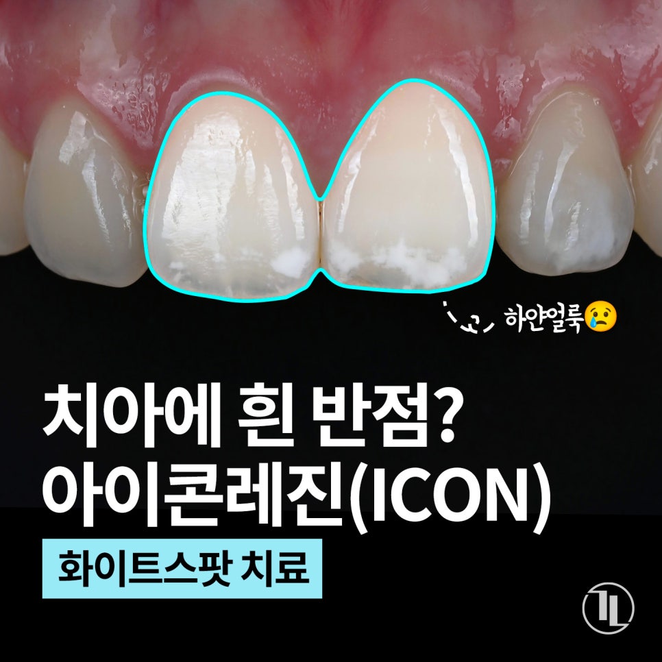 치아에 흰 반점? 화이트스팟 예방법과 치료 방법, 아이콘레진 / 강남레옹치과 관련 이미지 1