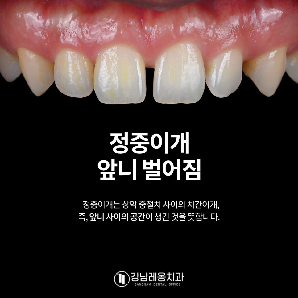 앞니 벌어짐 치료 후기 / 아이 앞니 벌어짐 건강하게 치료하려면? / 강남레옹치과 관련 이미지 1