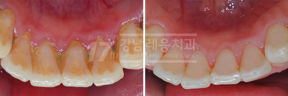 올바른 잇솔질이 왜 중요한지 예방중심 강남역치과의 설명 관련 이미지 2