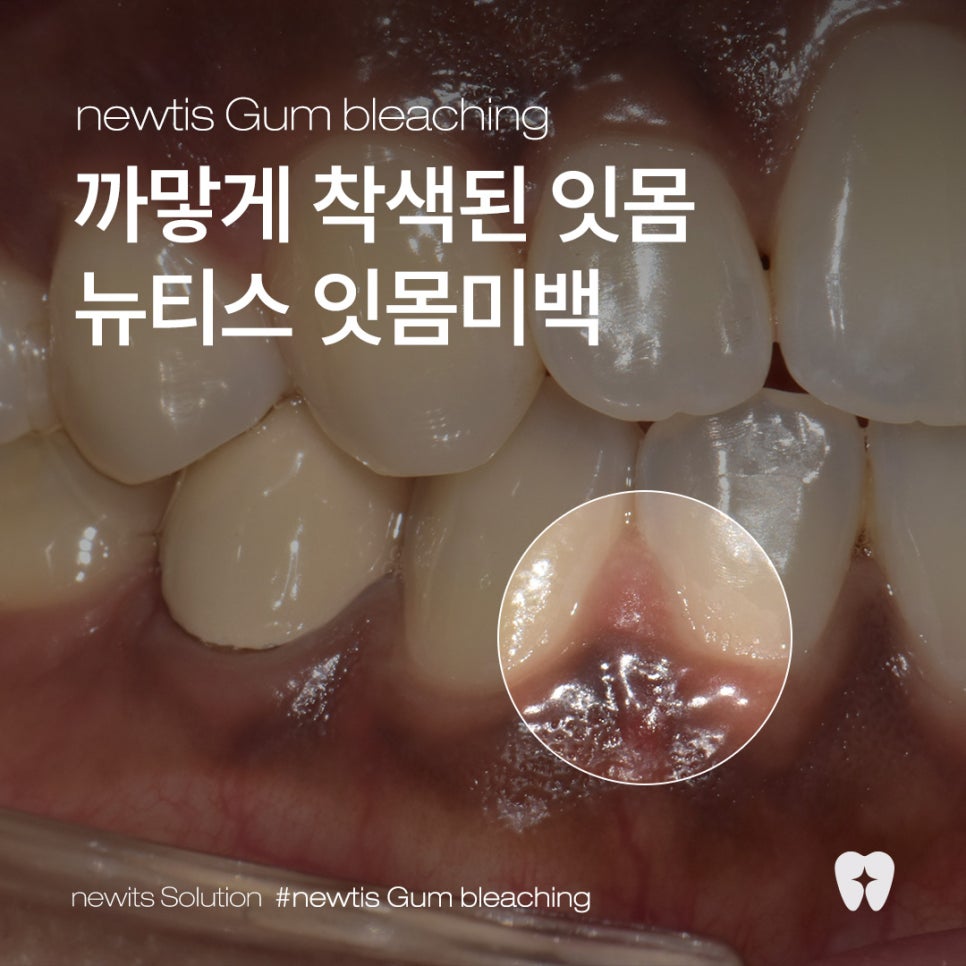 잇몸미백 효과 있나요? 시술 전후와 유지기간, 부작용까지!  / 강남레옹치과 뉴티스 잇몸미백 관련 이미지 1