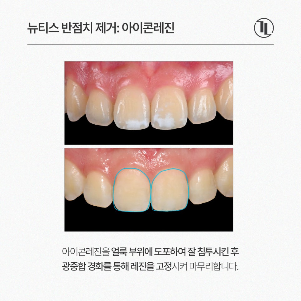 길이가 고르지 않은 반점치, 뉴티스 솔루션 / 아이콘레진 국내 사용량 1위 치과 관련 이미지 4