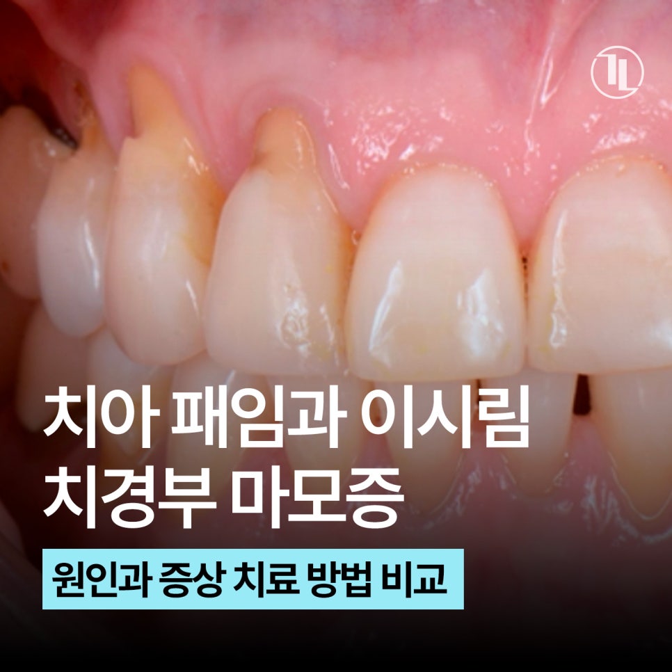 Tooth Notches and Tooth Sensitivity? Cervical Abrasion / Comparing Causes and Treatment Methods / Gangnam Leon Dental Clinic image 1