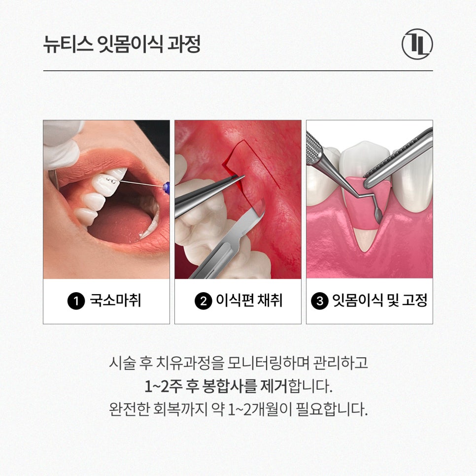잇몸 내려앉음, 잇몸퇴축 잇몸이식으로 개선 / 강남레옹치과 관련 이미지 4