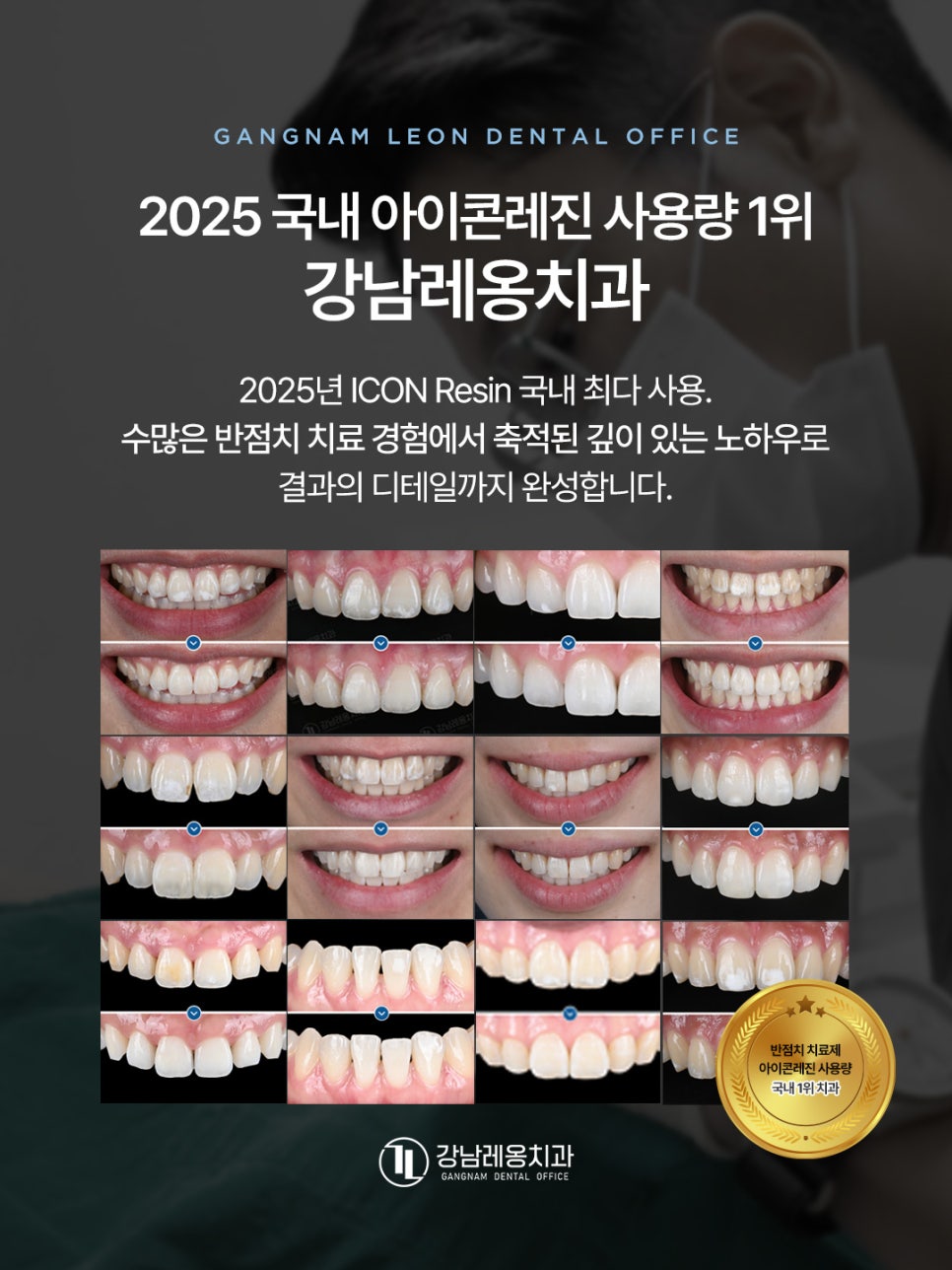 앞니 하얀 얼룩, 반점치 치료 케이스 / 아이콘레진 치료 방법 / 강남레옹치과 관련 이미지 8