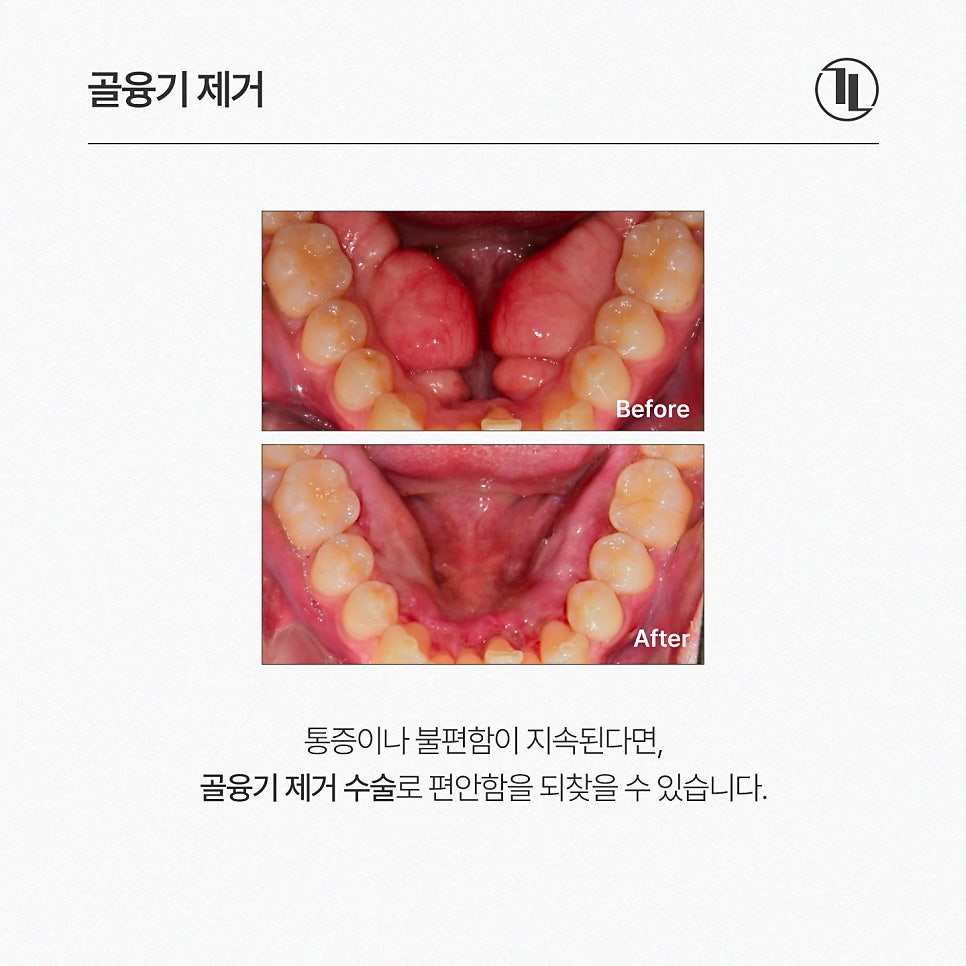 입안에서 느껴지는 딱딱한 이물감? 잇몸뼈 돌출 골융기 제거 / 강남레옹치과 관련 이미지 5
