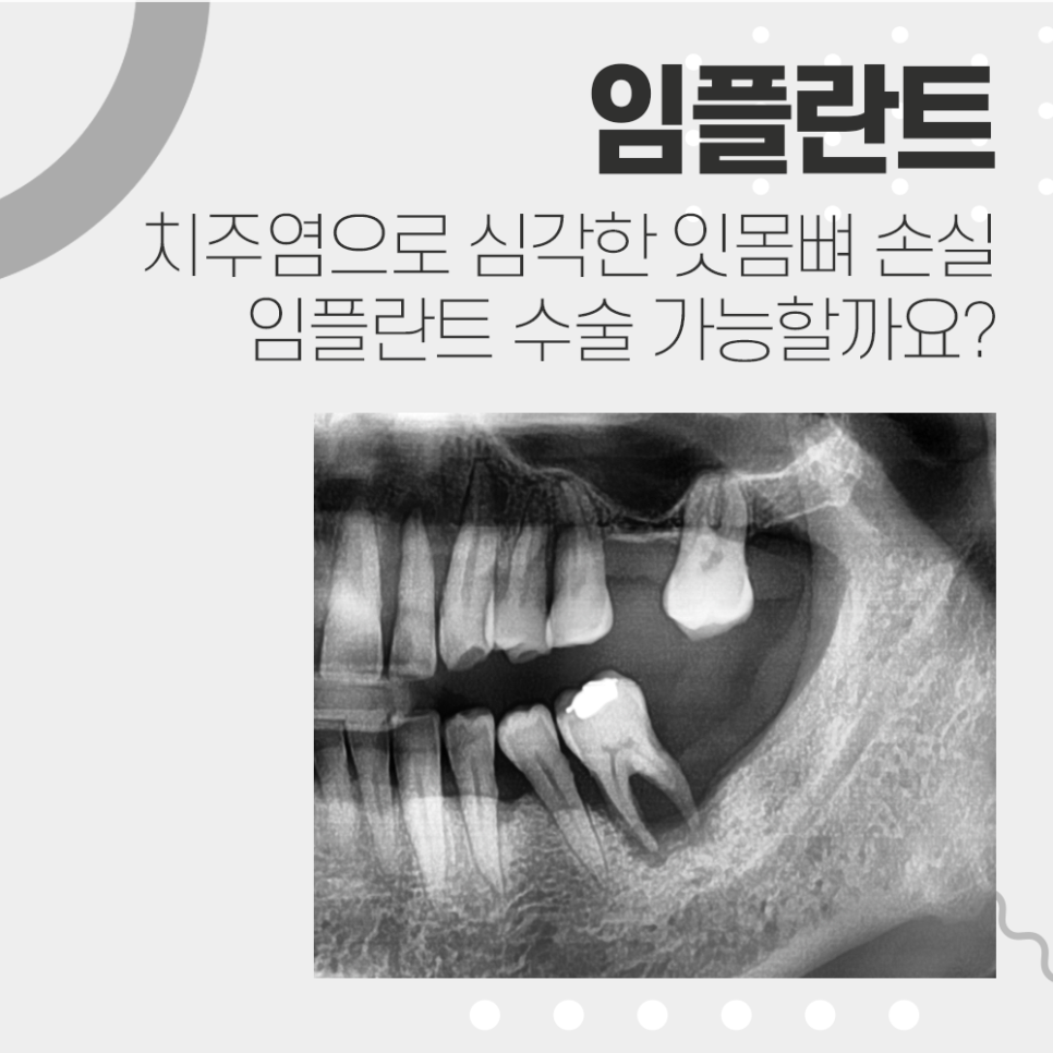 잇몸 염증 때문에 치조골 흡수, 발치 후 임플란트 수술 관련 이미지 1