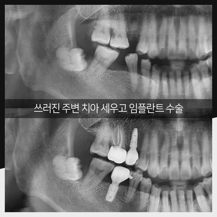 강남레옹치과 임플란트 수술 증례 한눈에 보기, 명불허전! 관련 이미지 4