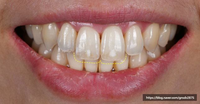 앞니에 하얀얼룩이? 앞니 길이가 달라요! / 앞니통합치료 뉴티스 반점치료 + 치아성형✨ / 강남레옹치과 관련 이미지 8