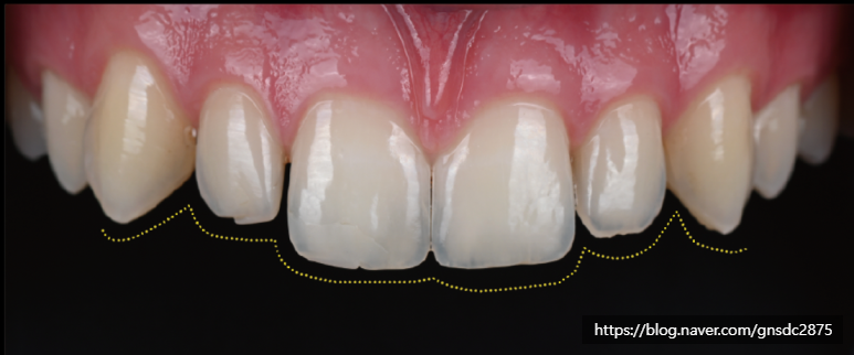 치아가 작아서 콤플렉스? 왜소치 개선 전후 사례👐 / 강남레옹치과 관련 이미지 3