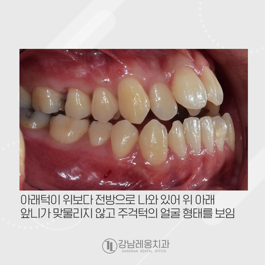 앞니가 물리지 않는 개방교합과 주걱턱을 치아교정으로 한번에..? 관련 이미지 3