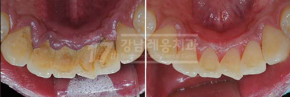 올바른 잇솔질이 왜 중요한지 예방중심 강남역치과의 설명 관련 이미지 4