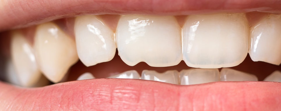 앞니에 하얀얼룩이? 앞니 길이가 달라요! / 앞니통합치료 뉴티스 반점치료 + 치아성형✨ / 강남레옹치과 관련 이미지 5